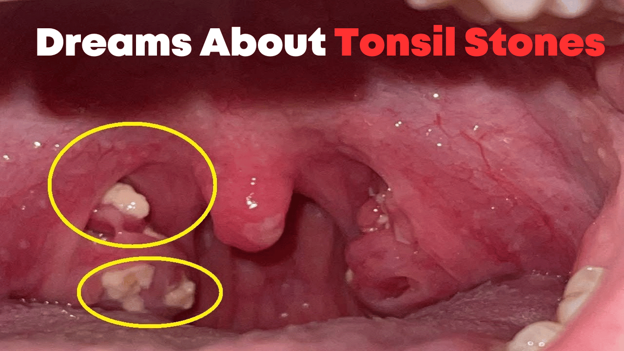 Dreams About Tonsil Stones